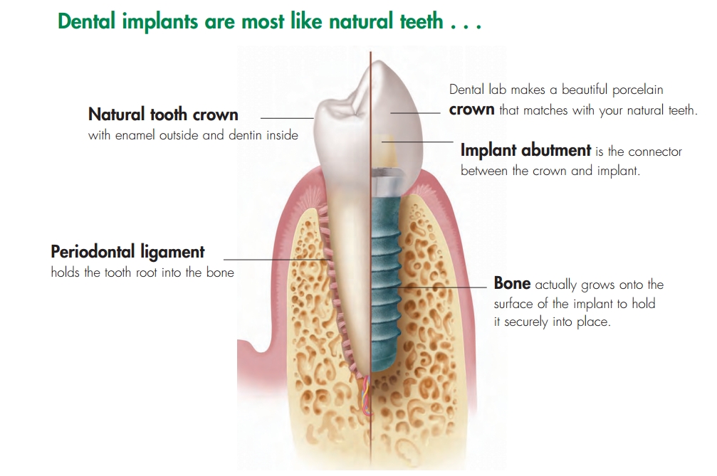 Dental Implants Family Dentistry Santa Cruz Calif